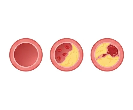Progression of plaque and clot formation in artery cross-sections